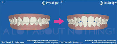 invisalign progress tray